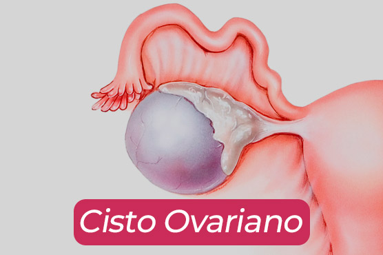 cisto-ovarianoo