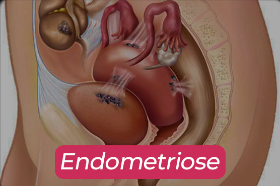 endometriosee