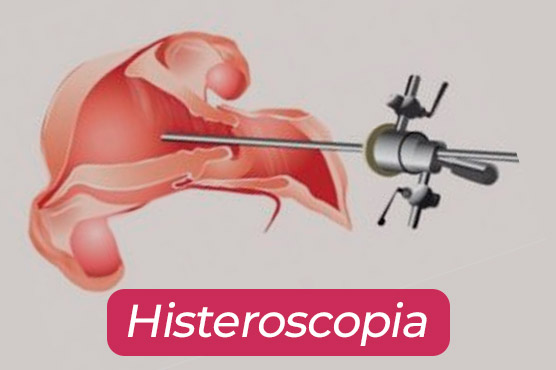 histeroscopiaa