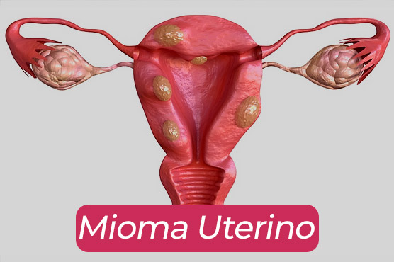 mioma-uterinoo